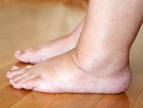 脚部的症状可能预示着心力衰竭、肝脏疾病或血栓